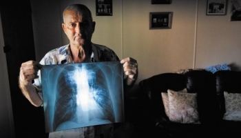 Впервые за последние 60 лет в Австралии шахтер заболел болезнью «черного легкого»